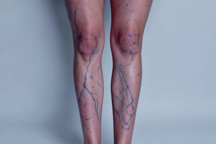 Pernas com veias azuis proeminentes sob a pele, em plano médio, com fundo neutro.