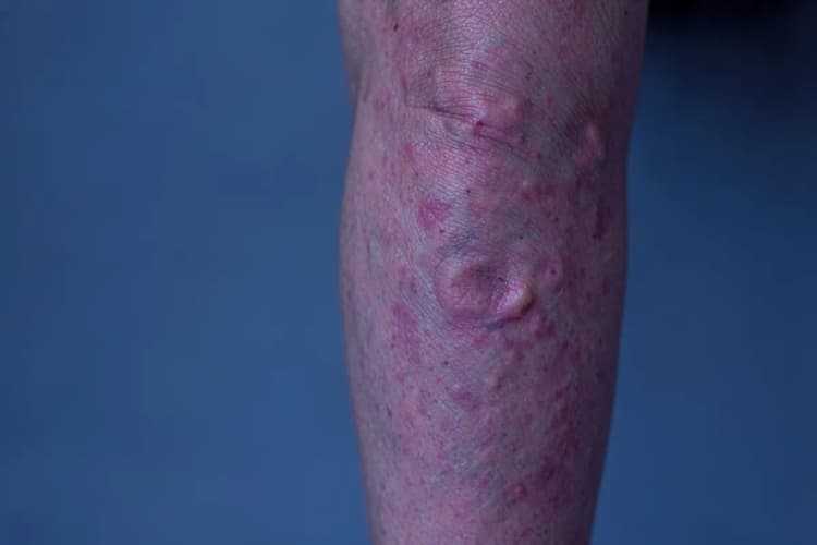 Perna com veias varicosas, em close-up, com foco na área afetada.