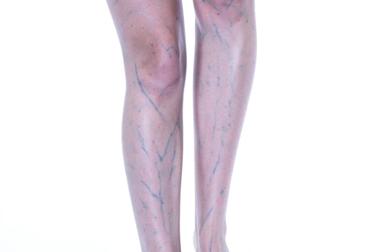 Pernas magras com veias azuis discretas, em plano detalhe, com fundo branco.