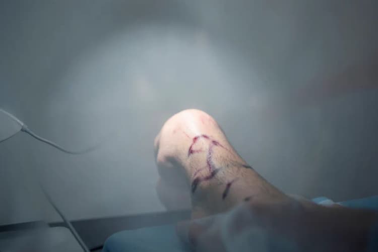 Uma perna com veias varicosas sendo examinada com um dispositivo médico, sugerindo diagnóstico.