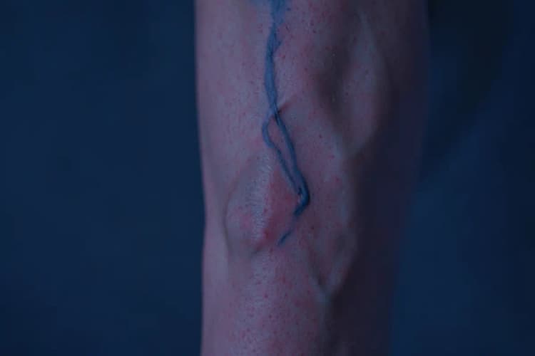 Close-up de uma veia varicosa azul e proeminente na perna.