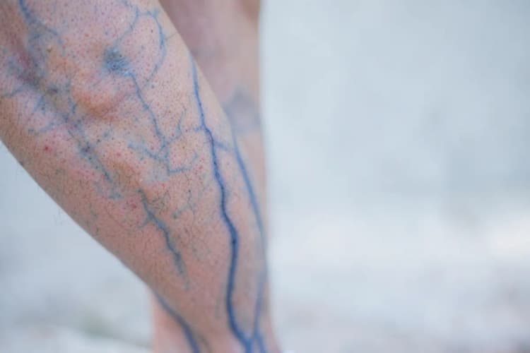 Veias azuis proeminentes sob a pele de uma perna, com destaque para a textura e o inchaço.