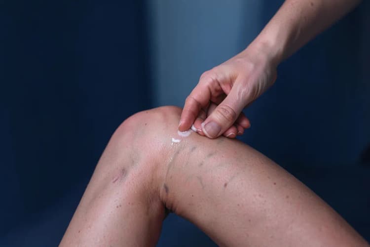 Perna com varizes recebendo massagem com pomada.