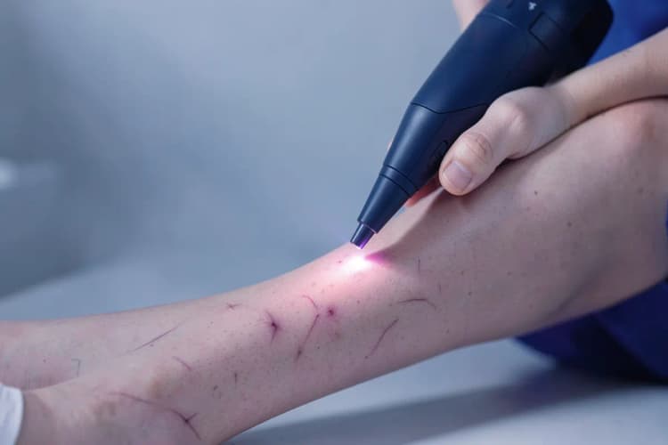 Técnica de secagem de vasinhos com laser, termo de busca: tratamento a laser para vasinhos