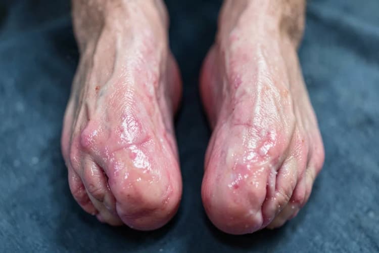 Pernas com inchaço visível nos tornozelos e pés, com a pele esticada e brilhante devido ao edema.