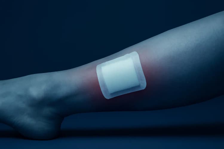 Perna com inchaço leve e vermelhidão após cirurgia de varizes, com curativo ainda no local